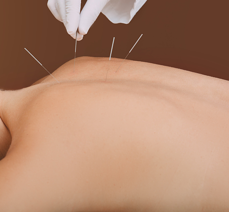 Acupuncture Treatments