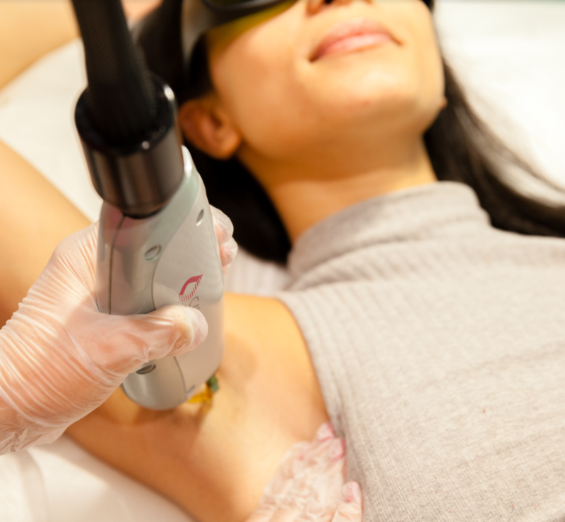 Laser Hair Removal