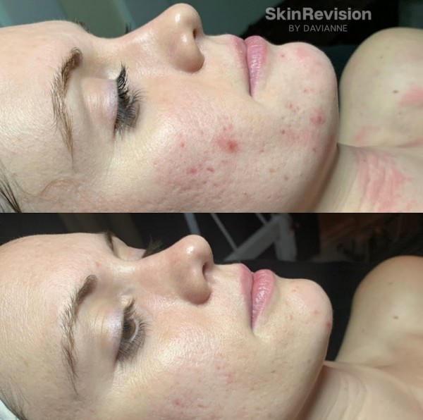 Slide image 12 of 13 for skin-revision-by-davianne