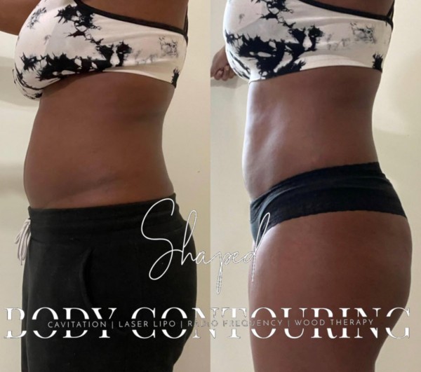Slide image 2 of 2 for shaped-body-contouring