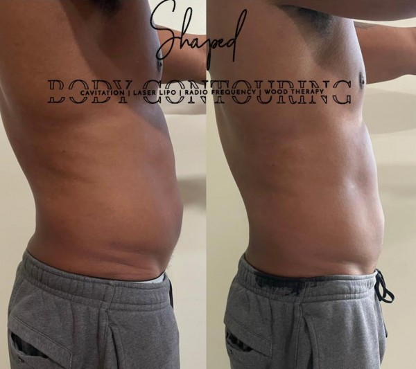 Slide image 1 of 2 for shaped-body-contouring