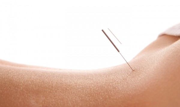 Slide image 1 of 3 for center-acupuncture