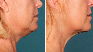double chin, Ultherapy, clayton med spa, medspa st. louis, botox st. louis