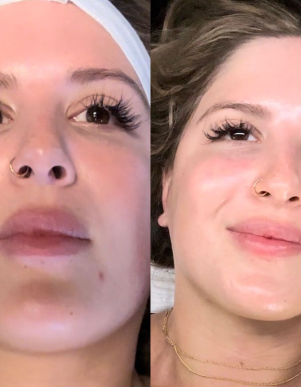 Client receiving a dermaplaning facial at Mod Esthetics for smooth skin results.